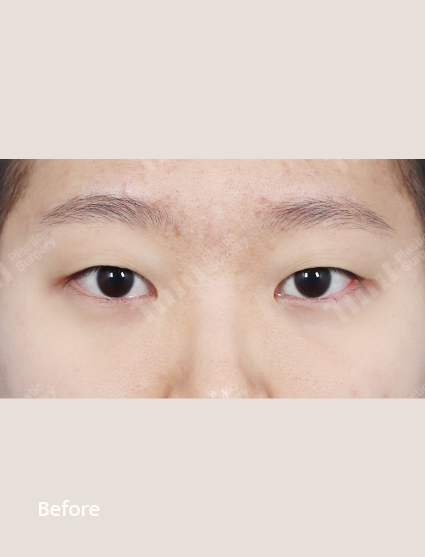Before