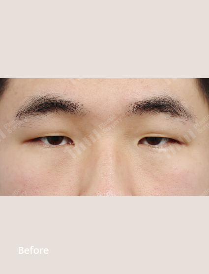 Before