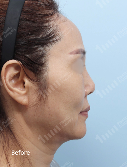 Before