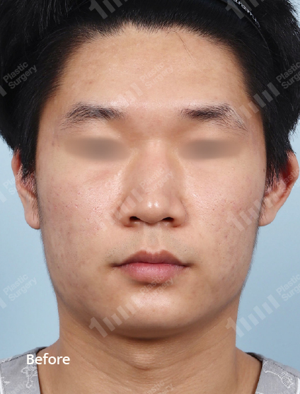 Before