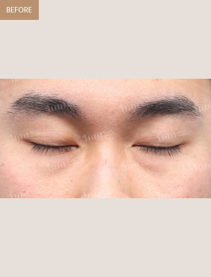 Before