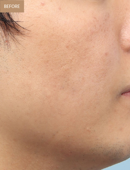 Before