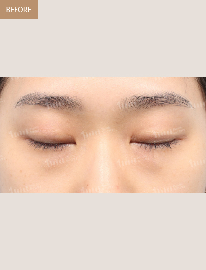 Before