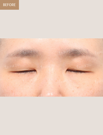 Before
