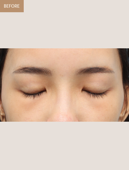 Before