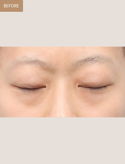 Before