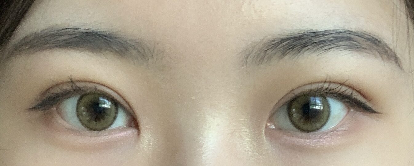 수술후