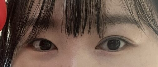 눈재수술전!