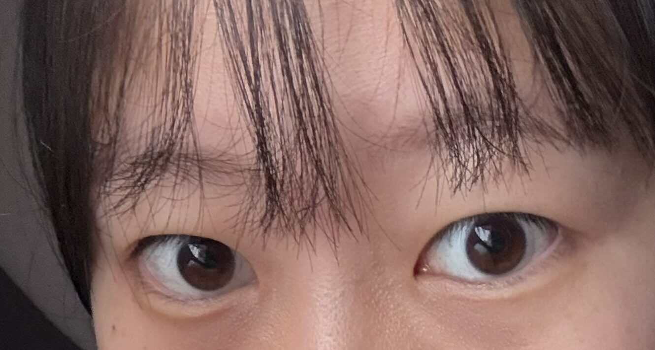 수술 전
